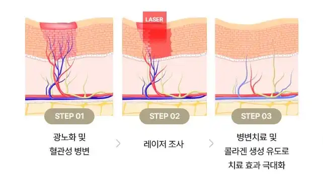 확장된 혈관 집중 치료