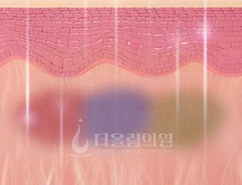 STEP 03. 색소 선택적 파괴
